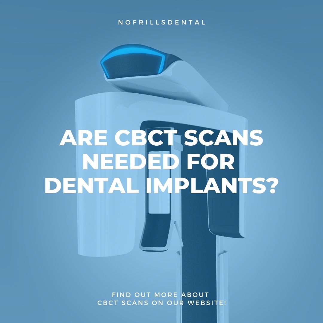 Are CBCT Scans Needed for Dental Implants?