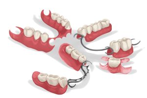 partial dentures