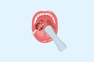 Oral Cancer Rec