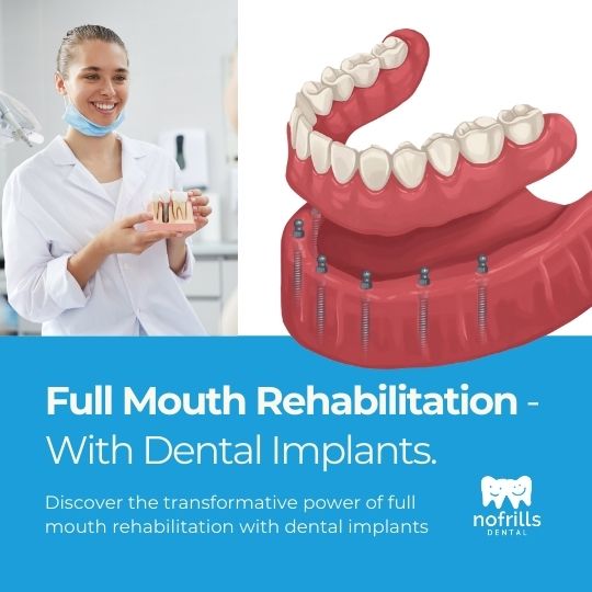 Full Mouth Rehabilitation With Dental Implants