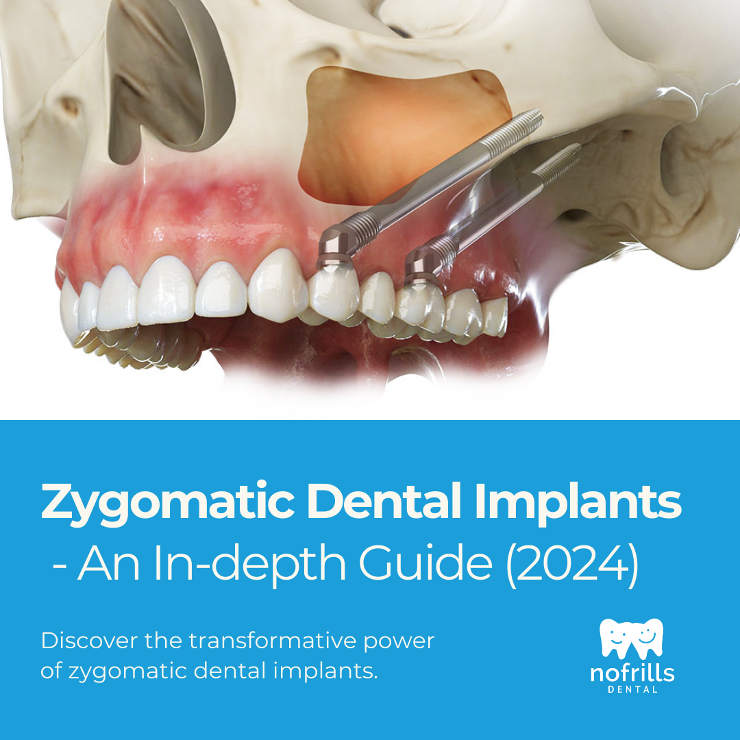 Zygomatic Dental Implants - A Permanent Solution for Missing Teeth Cover